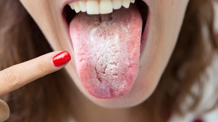 Ce este candidoza orală (ciuperca limbii)? Cum se vindecă candidoza?