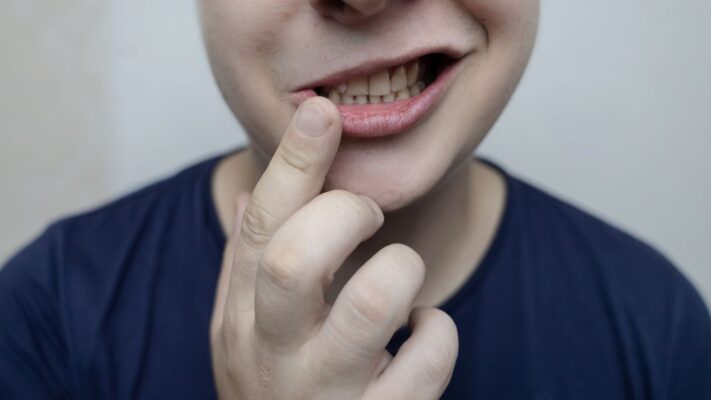 Yüz Felci Geçirenlerin Yorumları