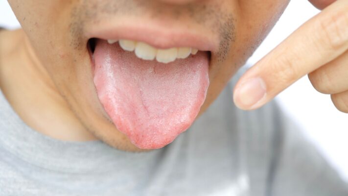 Dildeki Beyazlık Hangi Hastalığın Belirtisidir?