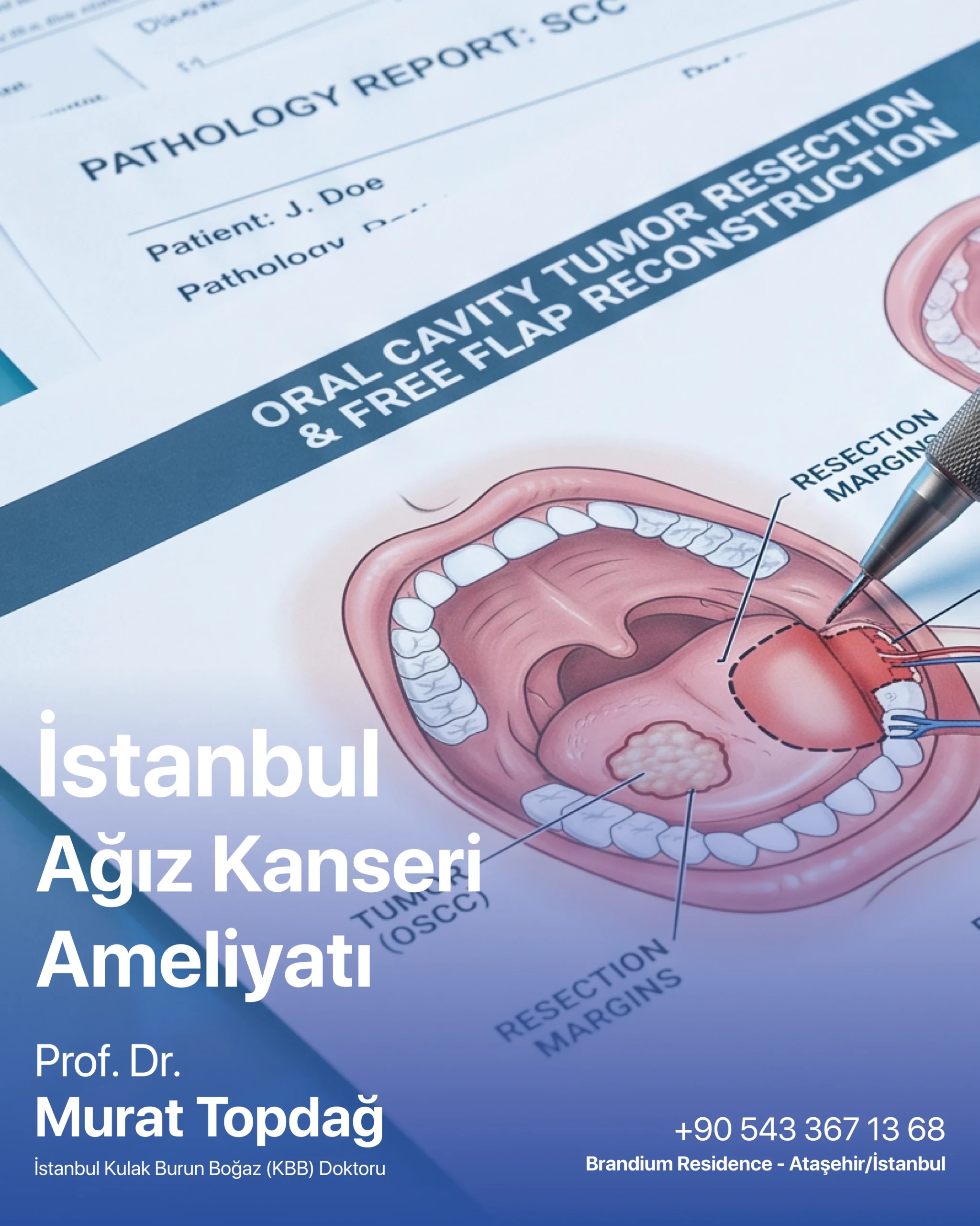 İstanbul Ağız Kanseri Ameliyatı