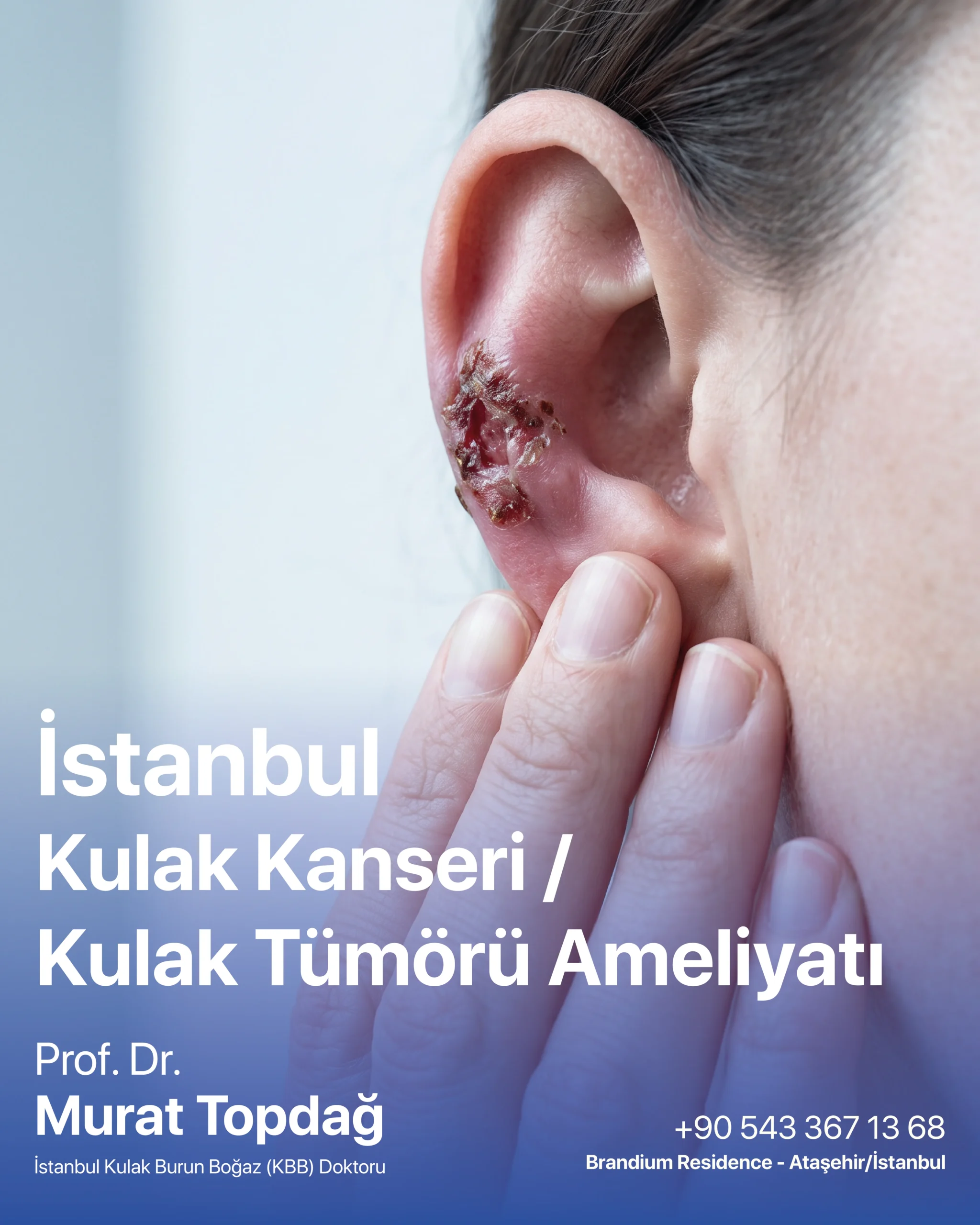 İstanbul Kulak Kanseri Kulak Tümörü Ameliyatı